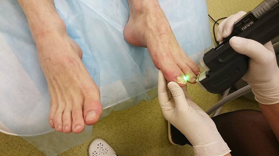 Laser treatment of onychomycosis