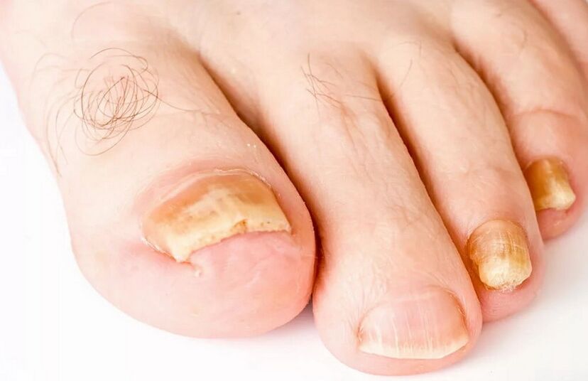 Onychomycosis
