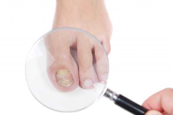 Toenail Fungus Development Stages and Stages