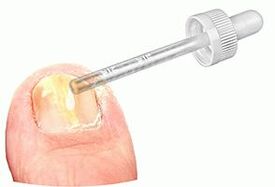 Apply drops to fungal-infected nails