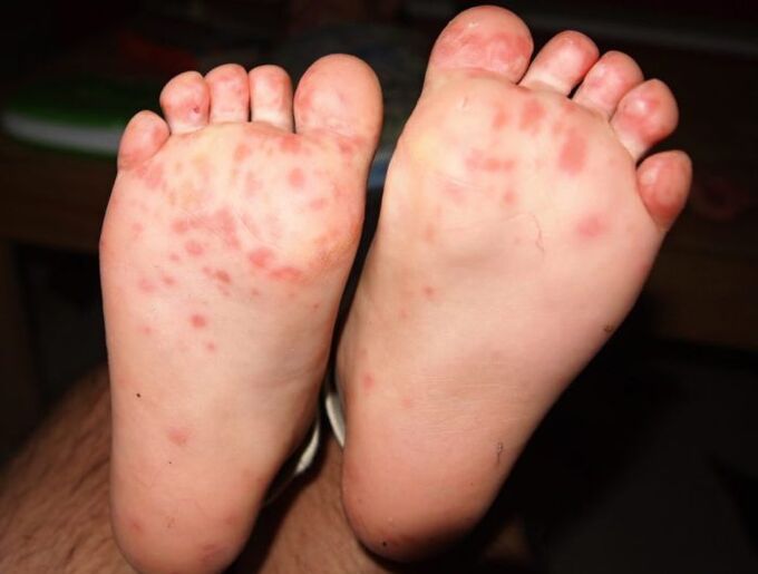 Blister fungus on legs