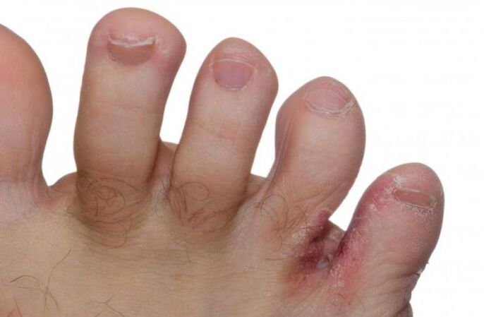 Fungus between toes on feet