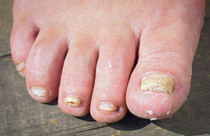 Red mold on feet