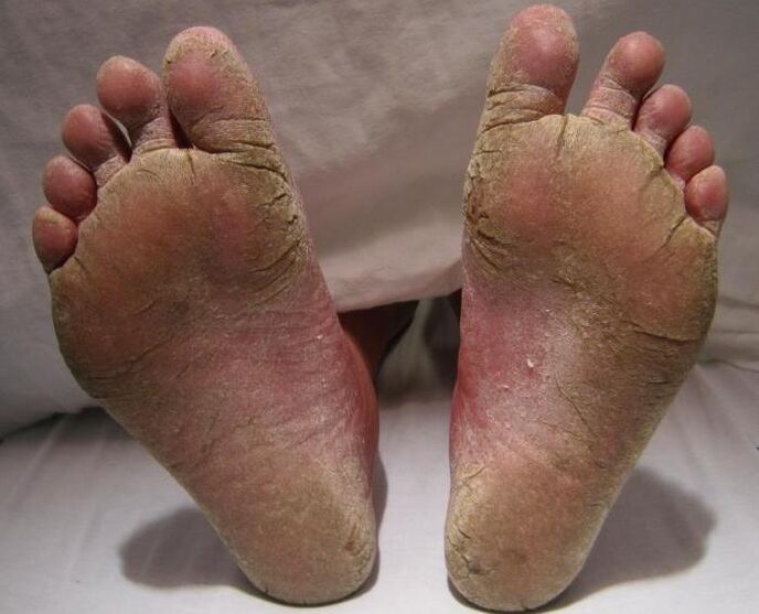 Squamous hyperkeratosis fungus on legs