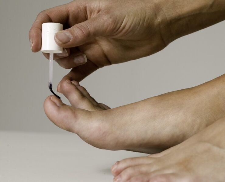 Application of medicinal varnish in the treatment and prevention of big toe onychomycosis