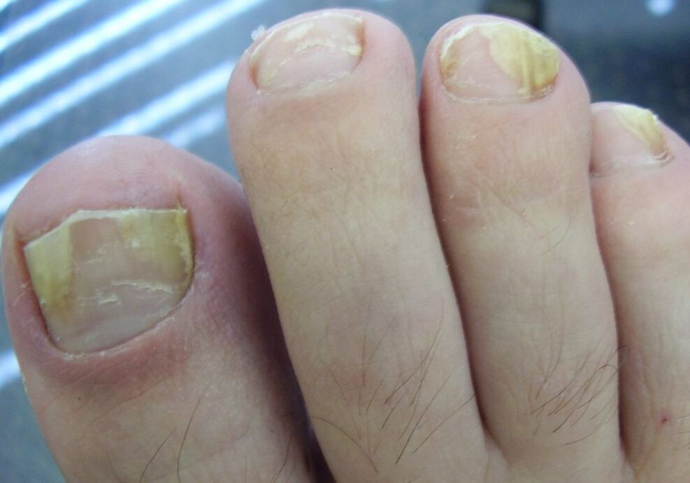 In the second stage of fungal infection, the nail plate turns yellow