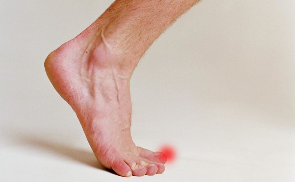 Onychomycosis on big toe