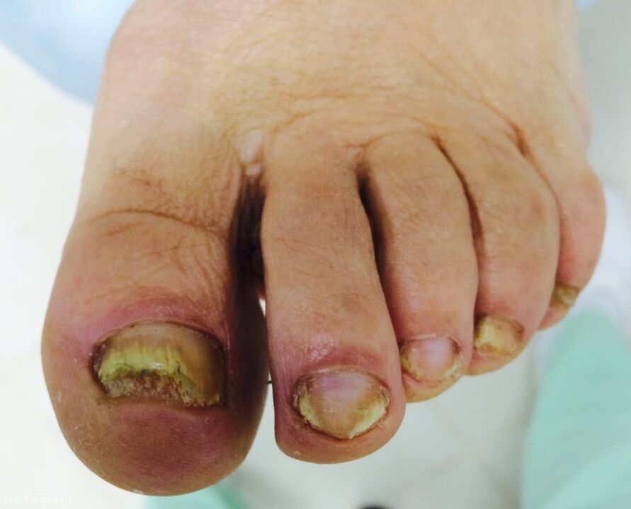 Severely deformed toenails are a sign of the third stage of fungus