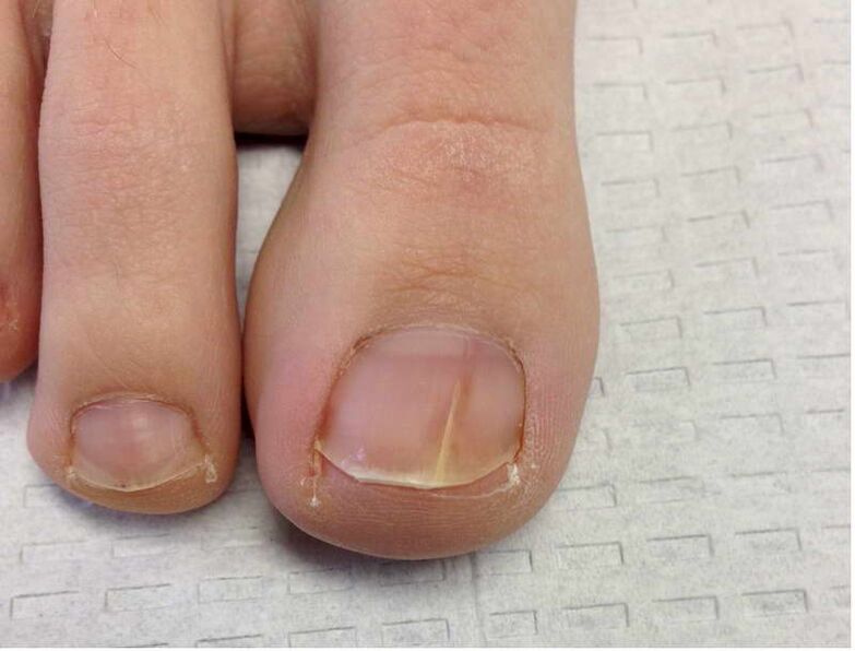 Stripes and spots appear on the big toenail in the first stage of fungal development