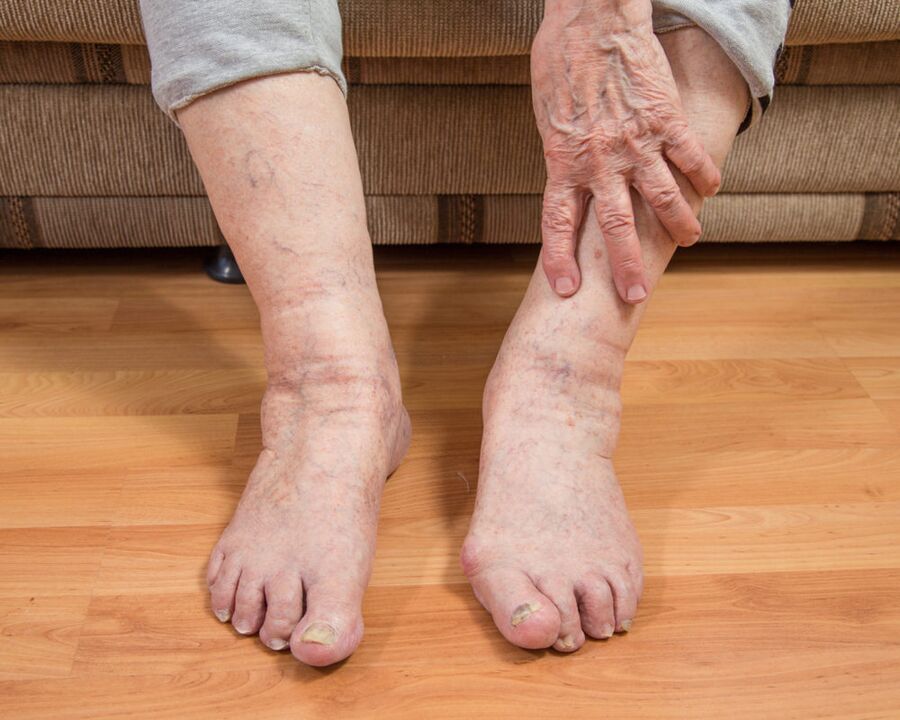 To avoid the spread of fungal microspores, do not walk barefoot in your home.