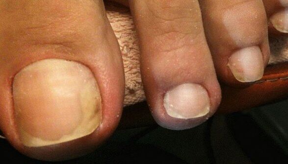 Early symptoms of onychomycosis